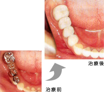 奥歯 メタルボンド（保険外）