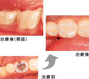 奥歯 エステニア（保険外）