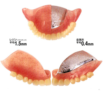 金属床義歯